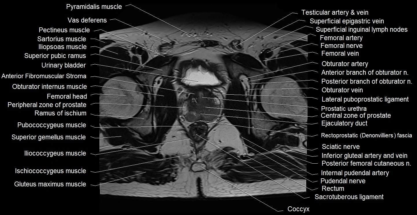 Male pelvis axial cross sectional anatomy image 31.webp